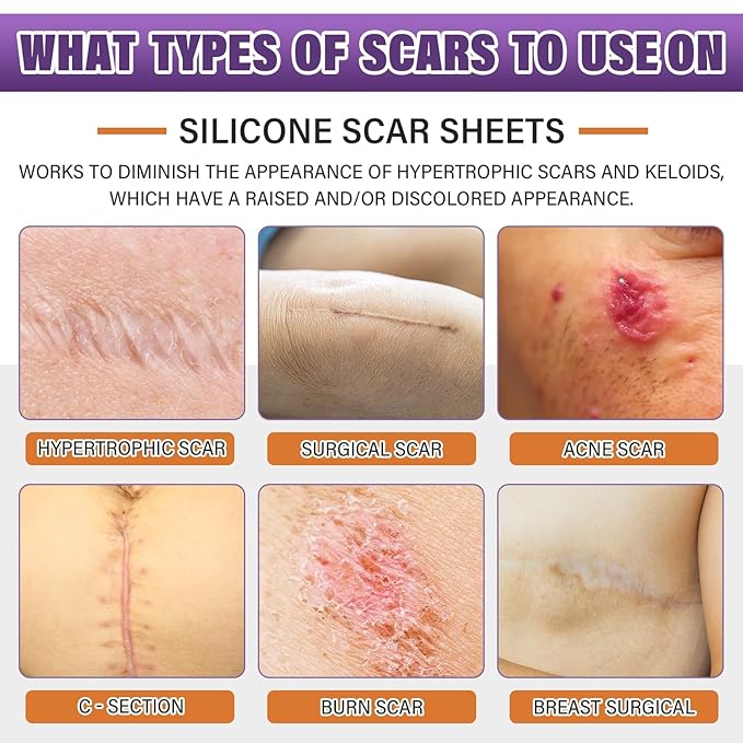 Silicone Scar Sheets,Silicone Scar Tape,Silicone Scar Removal Strips for Surgical,C-Section,Tummy Tuck,Keloid Scars (1.6"X 120" Roll-3M) Keloid Bump Removal
